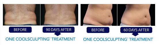 Philadelphia CoolSculpting®: Non-Invasive Body Sculpting